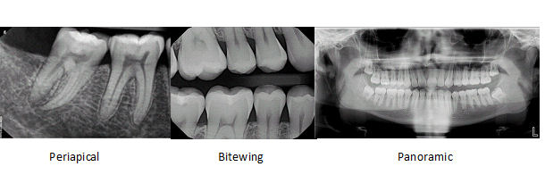 taking bitewing dental x rays