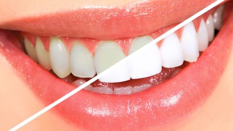 Teeth Whitening Tips and Services in Virginia Beach
